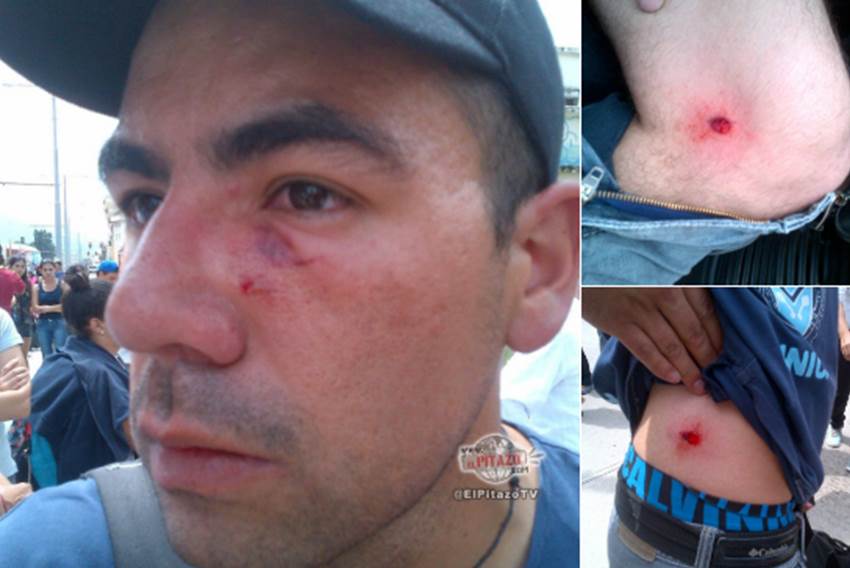 Emmanuel Rivas recibió tres impactos de perdigón cuando intentaba fotografiar a una joven herida. Foto. Cortesía, El Pitazo. 